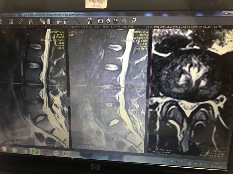 Грыжа позвоночника это приговор